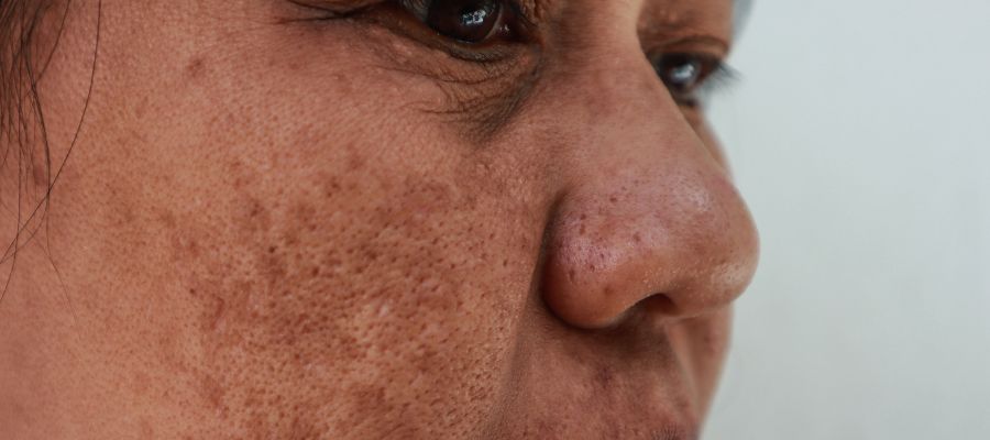 Mulher com Melasma, manchas escuras, causas do melasma, tratamento do melasma, Lavieen, laser de Erbium, protetor solar, manchas na pele, hiperpigmentação.